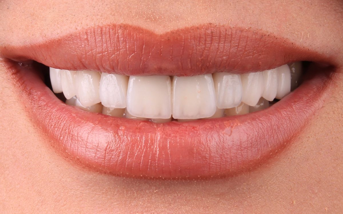 After: even, bright white upper teeth with uniform shape and length, front view