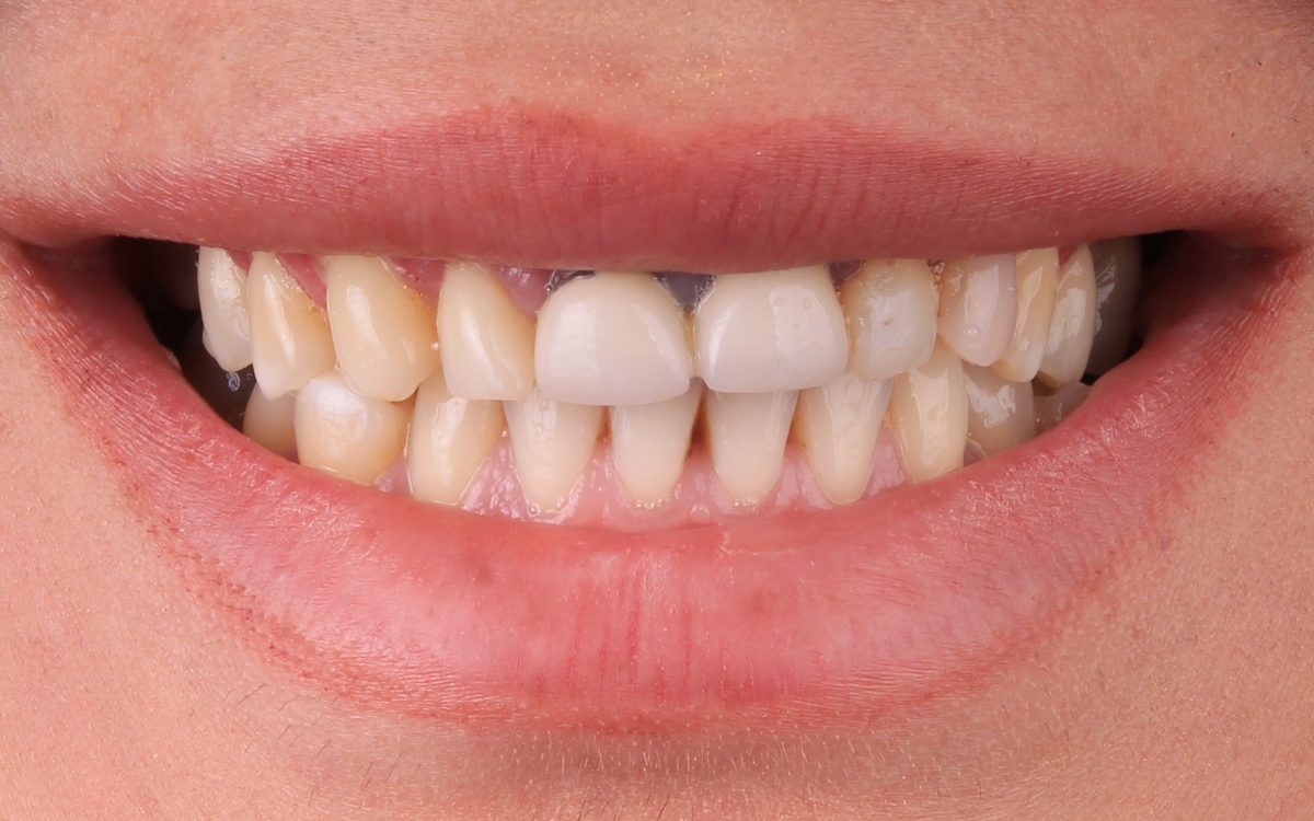 Before: crowded, uneven, yellowed upper and lower front teeth with dark spaces between them, front view