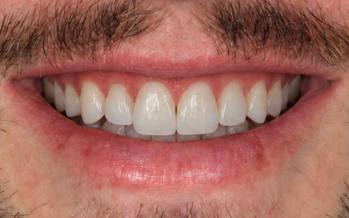 After: even, smooth front teeth with the gap between the two front teeth closed
