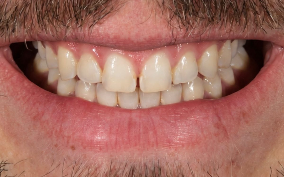 Before: front teeth with worn, uneven older composite and a visible gap between the two front teeth