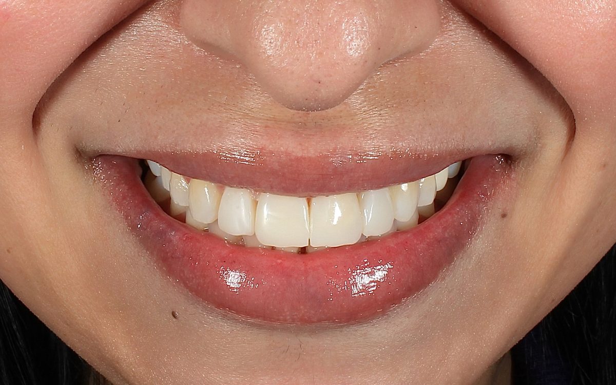 After: front teeth with smooth, even edges and no gaps, front view