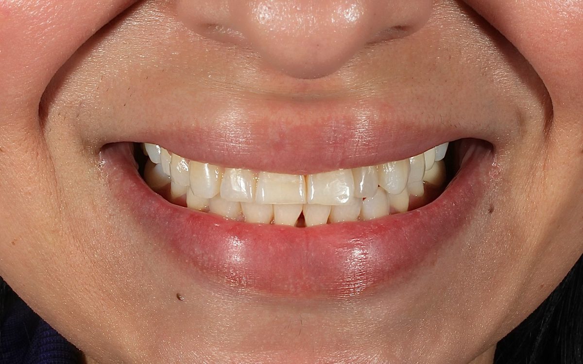Before: front teeth with chipped, uneven edges and small gaps, front view