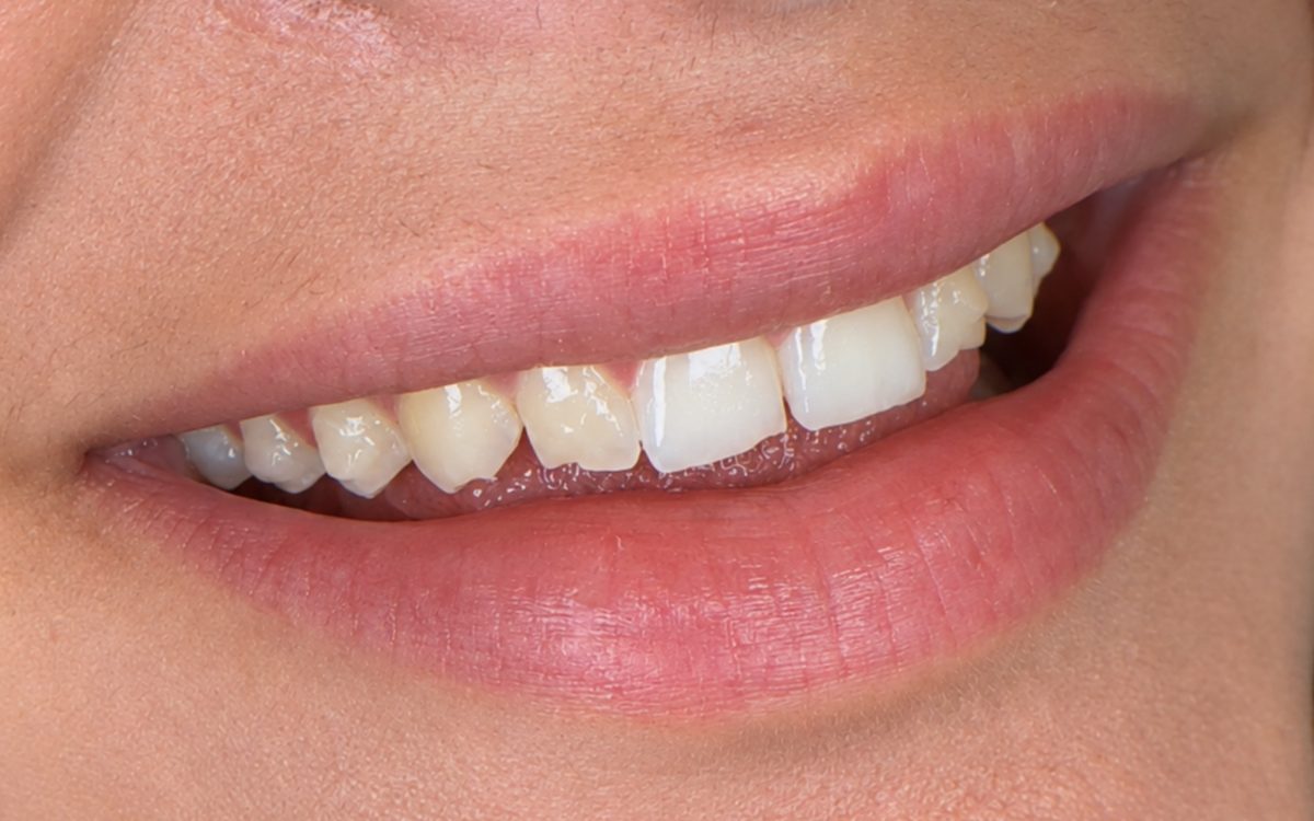 Before: uneven front teeth with chipped edges and mismatched color, side view