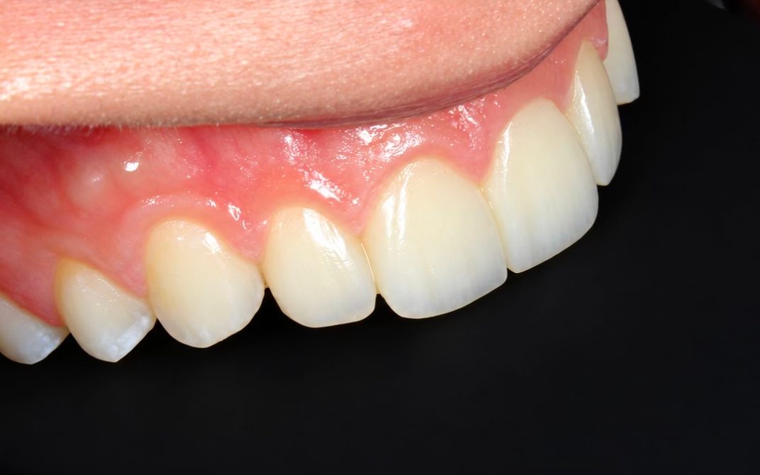 After: close-up of upper front teeth with rebuilt, smooth edges